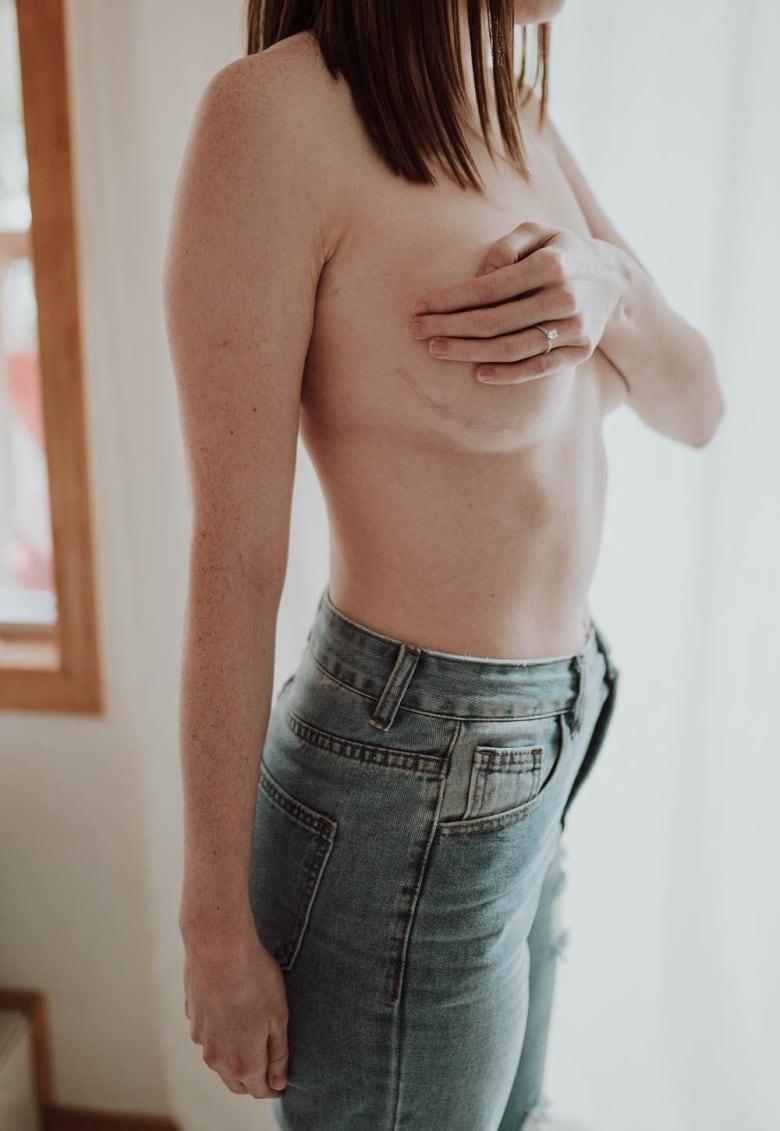 A woman stands showing off her scar from her double mastectomy. 