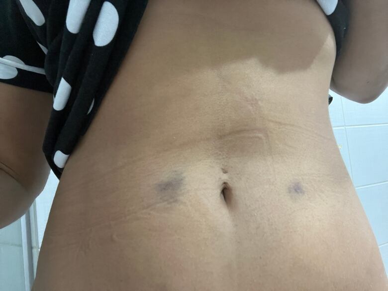 A close-up of a woman's bruised stomach.